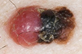 Et eksempel på melanom med flere farver