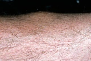 Erythema nodosum bump på kalven