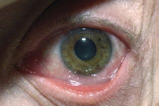 En herpes simplex øjeninfektion kan få øjet til at rødme og svulme op