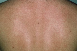 Et plettet udslæt på bagsiden af en person med mørk hud