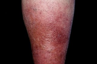 Cellulitis på underbenene