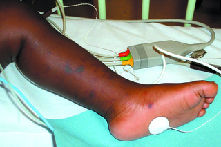 Billede af meningitis udslæt på ben og fod af mørkhåret barn