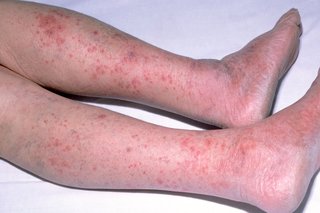 Billede af meningitis udslæt på ben og fødder af et hvidt barn