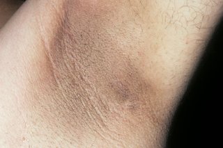 Acanthosis nigricans på armhulen