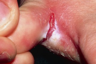 Revnet hud mellem tæerne forårsaget af atletens fod
