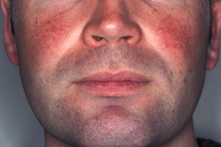 Billede af røde pletter på en mands kinder forårsaget af rosacea.