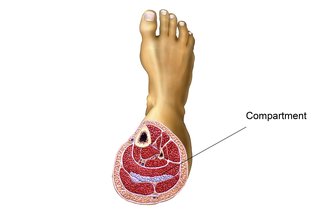 Billede af compartment syndrom