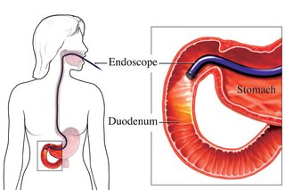 Diagram, der viser en endoskopi