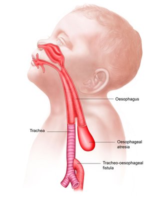 Diagram, der viser øsofageal atresi og tracheo-øsofagus fistel