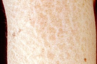Et nærbillede af en persons arm eller ben, der viser den tørre, skællede hud af ichthyosis.