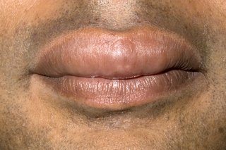 Billede af hævede læber forårsaget af angioødem