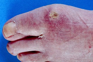 Billede af sklerodermi på en fod