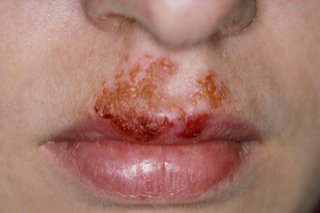 Billede af impetigo i ansigtet