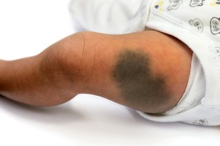 Billede af et asiatisk barns ben med et stort, mørkt farvet fødselsmærke, der ligner et blå mærke