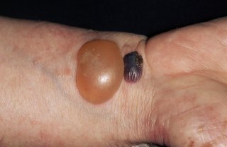 En stor orange blister og en mindre, mørk blister på håndleddet til en person med hvid hud
