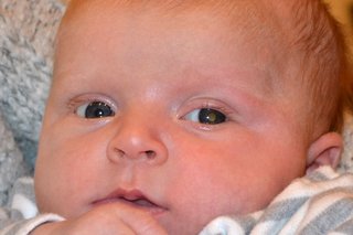 Et nærbillede af et barns ansigt, der viser den karakteristiske hvide refleksion i øjenpupillen