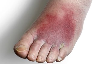 En fod påvirket af cellulitis