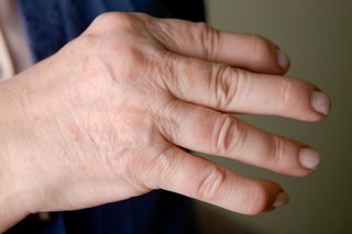 Nærbillede af en persons hånd, der viser gigt i leddene i fingrene