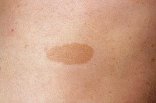 Nærbillede af et fladt, lysebrunt plaster på en persons hud
