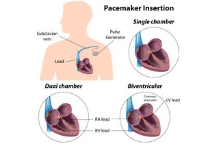 Diagram over forskellige typer pacemaker