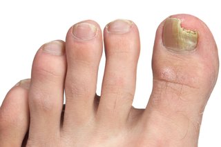 En knækket tånegl forårsaget af en svampe negleinfektion.