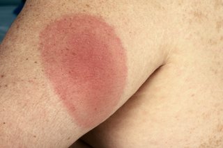 En cirkulær rød Lyme sygdom udslæt på en arm.