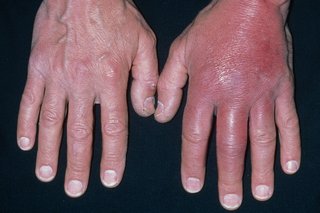 Hævede hænder forårsaget af cellulitis