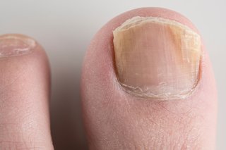 En svampespikinfektion på kanten af en tånegl.