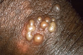 Herpes blærer på en penis hud