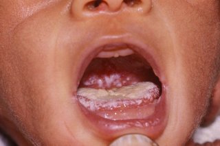 Hvid belægning på barnets tunge
