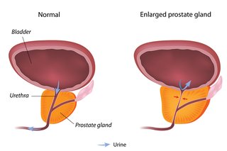Diagram over en normal prostata og en forstørret prostata.