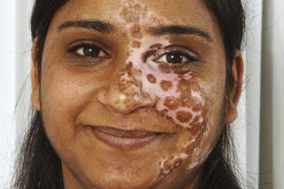 Billede af en kvinde med segmenteret vitiligo, der påvirker ansigtet