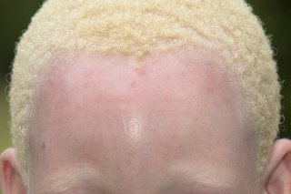 En afrikansk pige med albinisme. Hun har bleg hud og kort, lysblondt hår.
