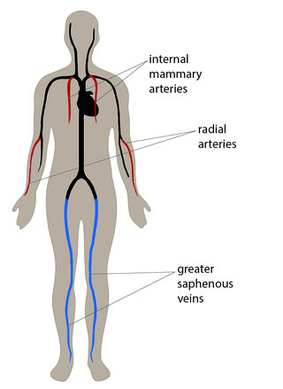 Illustreret diagram, der viser placeringen af indre brystarterier i brystet, radiale arterier i underarmene og større saphenøse vener i benene