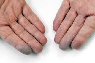 Blå fingre forårsaget af Raynauds