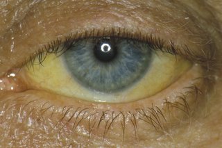 Billede, der viser gule øjne