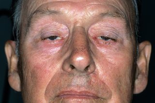 Et nærbillede af en mand med hængende øjenlåg forårsaget af myasthenia gravis
