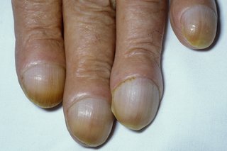 Klumpede fingernegle, der kurver over afrundede fingerspidser