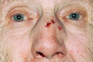 En ældre dame med snit på næsen og næseblod