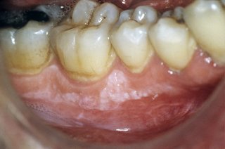 Et svagt hvidt plaster på tandkødet lige under tænderne