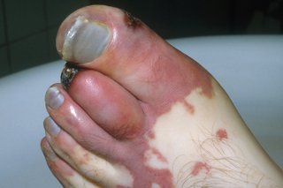 Billede af en fod påvirket af koldbrand