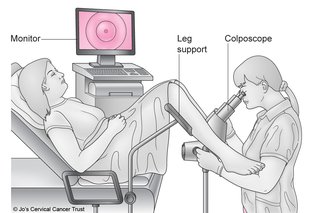 Diagram, der viser en kolposkopi