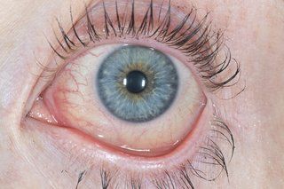 Et rødt og vandigt øje forårsaget af konjunktivitis