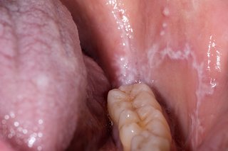 Åben mund med nederste række af tænder med hvide pletter på tungen og inde i kinden
