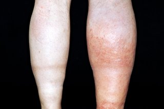 Rødt og hævet højre ben forårsaget af DVT