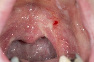 Røde pletter i munden forårsaget af oral trøske