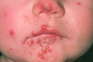 Lille barn med sår og blærer i ansigtet