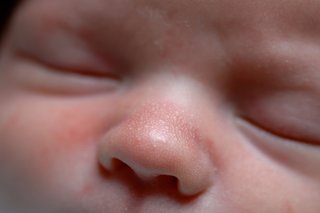 Hvide pletter på babyens næse