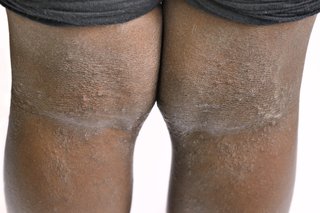 Billede af eksem på bagsiden af knæene