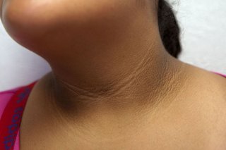 Acanthosis nigricans på nakken